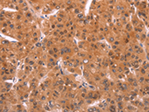 Immunohistochemistry of paraffin-embedded Human liver cancer tissue using TA367043 (EMP2 Antibody) at dilution 1/20 (Original magnification: x200)