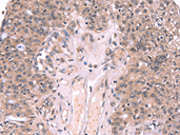 Immunohistochemistry of paraffin-embedded Human ovarian cancer tissue using TA367052 (EXTL1 Antibody) at dilution 1/20 (Original magnification: x200)