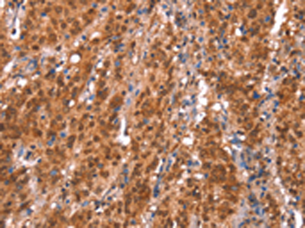 Immunohistochemistry of paraffin-embedded Human gasrtic cancer tissue using TA367063 (KCNJ6 Antibody) at dilution 1/20 (Original magnification: x200)