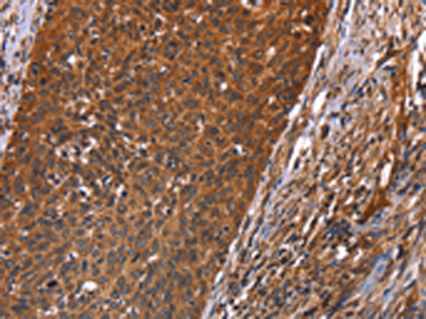 Immunohistochemistry of paraffin-embedded Human cervical cancer tissue using TA367074 (GUK1 Antibody) at dilution 1/40 (Original magnification: x200)