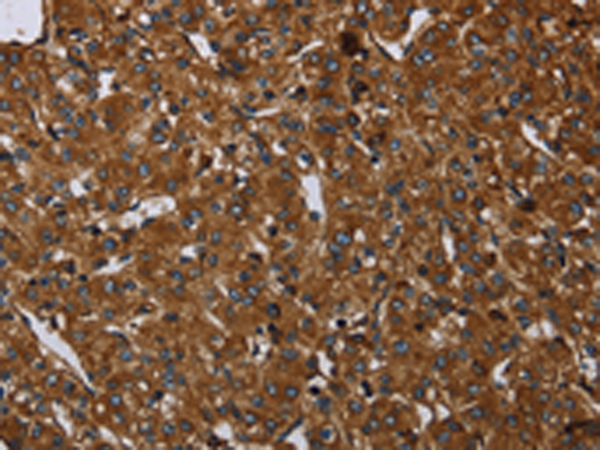 Immunohistochemistry of paraffin-embedded Human prostate cancer tissue using TA367117 (ARHGEF12 Antibody) at dilution 1/20 (Original magnification: x200)