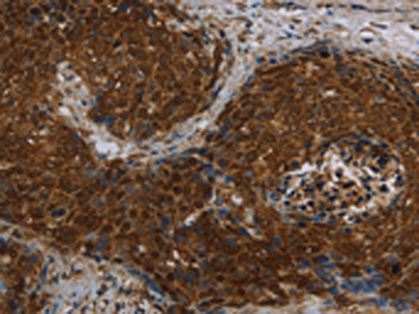 Immunohistochemistry of paraffin-embedded Human cervical cancer tissue using TA367119 (CERS5 Antibody) at dilution 1/40 (Original magnification: x200)
