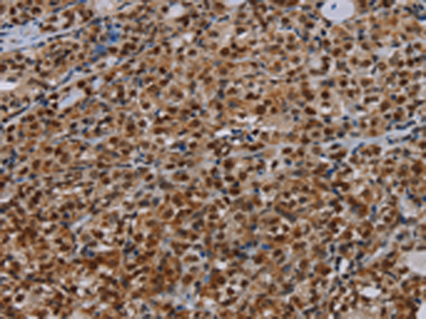 Immunohistochemistry of paraffin-embedded Human thyroid cancer tissue using TA367163 (DCAF6 Antibody) at dilution 1/30 (Original magnification: x200)