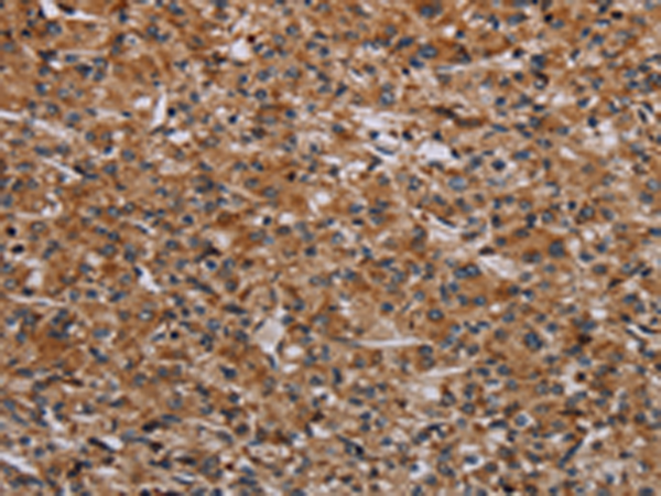 Immunohistochemistry of paraffin-embedded Human prostate cancer tissue using TA367175 (RPS6KB2 Antibody) at dilution 1/40 (Original magnification: x200)