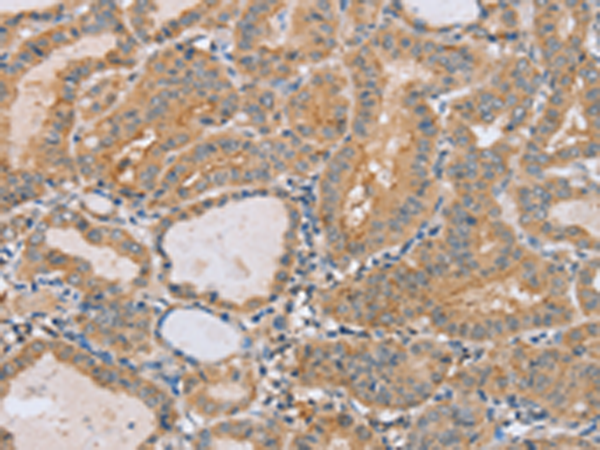 Immunohistochemistry of paraffin-embedded Human thyroid cancer tissue using TA367211 (PTPN4 Antibody) at dilution 1/40 (Original magnification: x200)