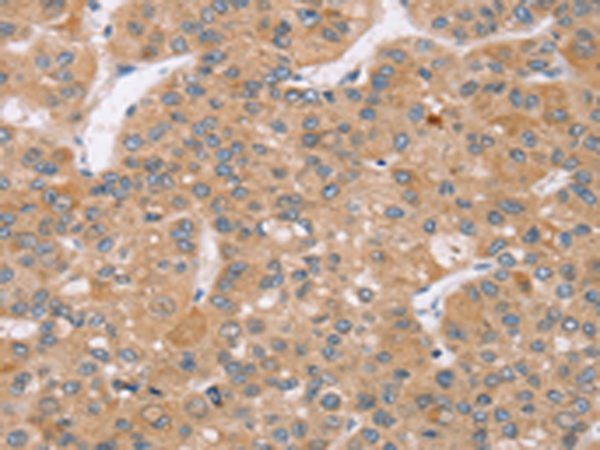 Immunohistochemistry of paraffin-embedded Human liver cancer tissue using TA367224 (TRIM34 Antibody) at dilution 1/35 (Original magnification: x200)