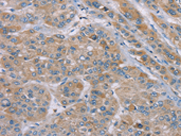 Immunohistochemistry of paraffin-embedded Human liver cancer tissue using TA367232 (SAMD9 Antibody) at dilution 1/35 (Original magnification: x200)