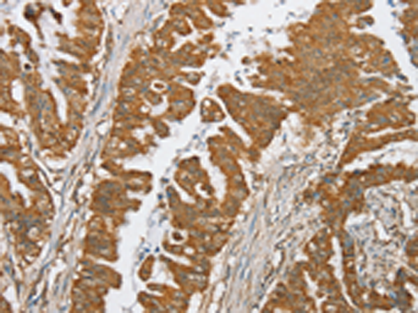 Immunohistochemistry of paraffin-embedded Human esophagus cancer tissue using TA367247 (SERINC2 Antibody) at dilution 1/20 (Original magnification: x200)