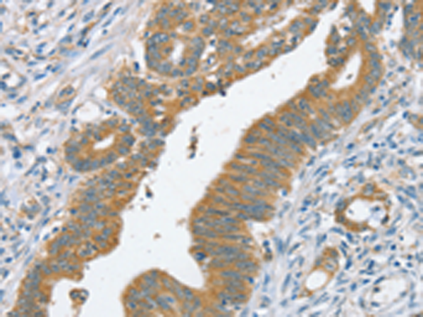 Immunohistochemistry of paraffin-embedded Human colon cancer tissue using TA367262 (SLC39A3 Antibody) at dilution 1/20 (Original magnification: x200)