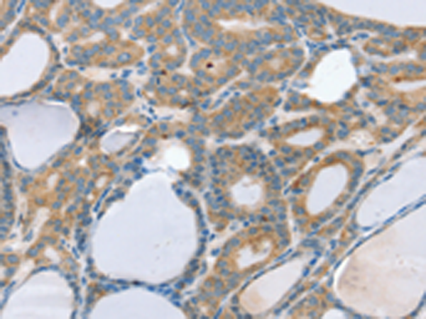 Immunohistochemistry of paraffin-embedded Human thyroid cancer tissue using TA367281 (SNX29 Antibody) at dilution 1/20 (Original magnification: x200)