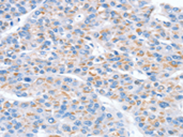 Immunohistochemistry of paraffin-embedded Human liver cancer tissue using TA367282 (SNX33 Antibody) at dilution 1/20 (Original magnification: x200)