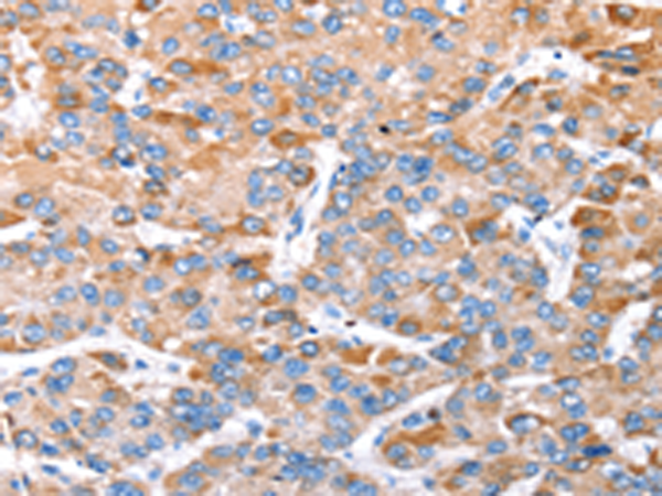 Immunohistochemistry of paraffin-embedded Human liver cancer tissue using TA367313 (TRIM14 Antibody) at dilution 1/35 (Original magnification: x200)