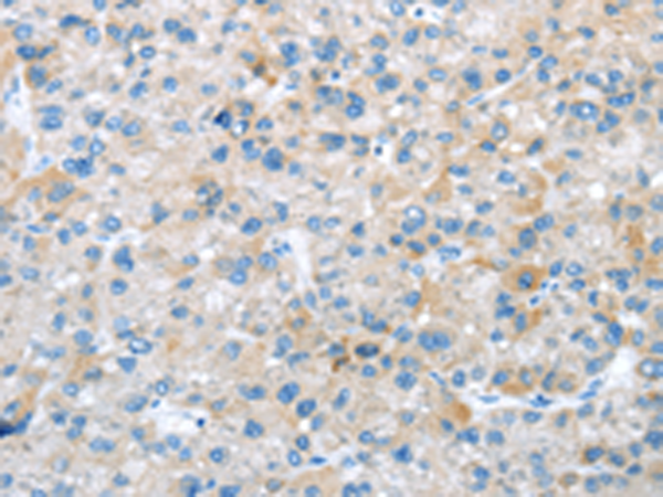 Immunohistochemistry of paraffin-embedded Human liver cancer tissue using TA367331 (TRIM47 Antibody) at dilution 1/20 (Original magnification: x200)