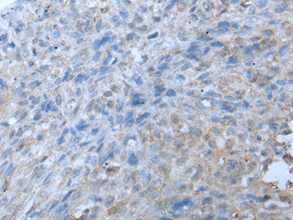 Immunohistochemistry of paraffin-embedded Human lung cancer tissue using TA367332 (TRIP11 Antibody) at dilution 1/20 (Original magnification: x200)