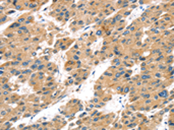 Immunohistochemistry of paraffin-embedded Human liver cancer tissue using TA367334 (TRPV5 Antibody) at dilution 1/25 (Original magnification: x200)
