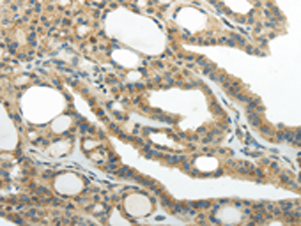 Immunohistochemistry of paraffin-embedded Human thyroid cancer tissue using TA367378 (SMYD2 Antibody) at dilution 1/30 (Original magnification: x200)