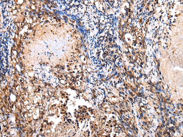 Immunohistochemistry of paraffin-embedded Human lung cancer tissue using TA367470 (COX8C Antibody) at dilution 1/20 (Original magnification: x200)