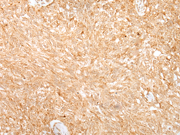 Immunohistochemistry of paraffin-embedded Human lung cancer tissue using TA367531 (ADAMTS3 Antibody) at dilution 1/25 (Original magnification: x200)