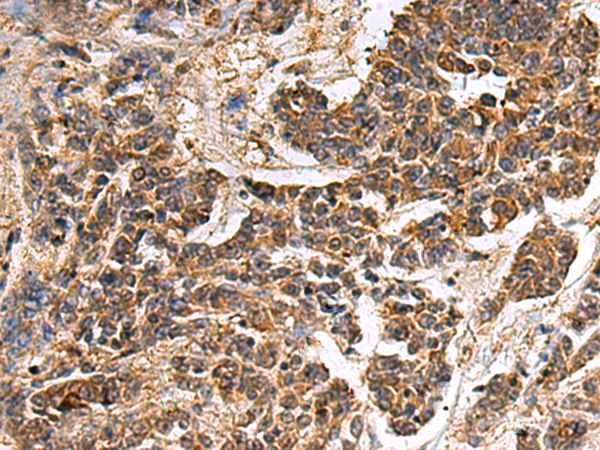Immunohistochemistry of paraffin-embedded Human colorectal cancer tissue using TA367536 (GANAB Antibody) at dilution 1/30 (Original magnification: x200)