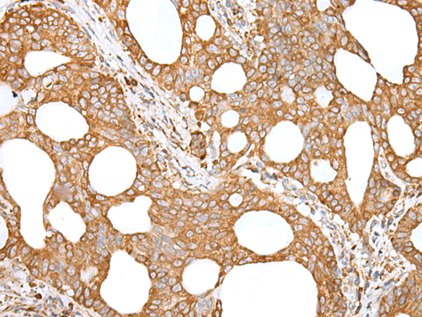 Immunohistochemistry of paraffin-embedded Human gastric cancer tissue using TA367537 (GANAB Antibody) at dilution 1/20 (Original magnification: x200)