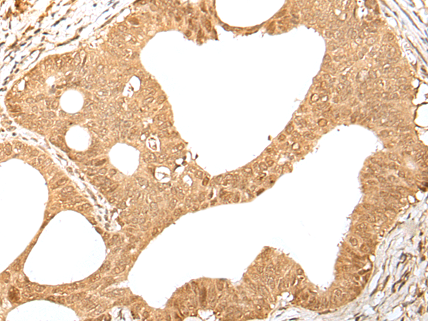Immunohistochemistry of paraffin-embedded Human gastric cancer tissue using TA367539 (KMT2B Antibody) at dilution 1/35 (Original magnification: x200)