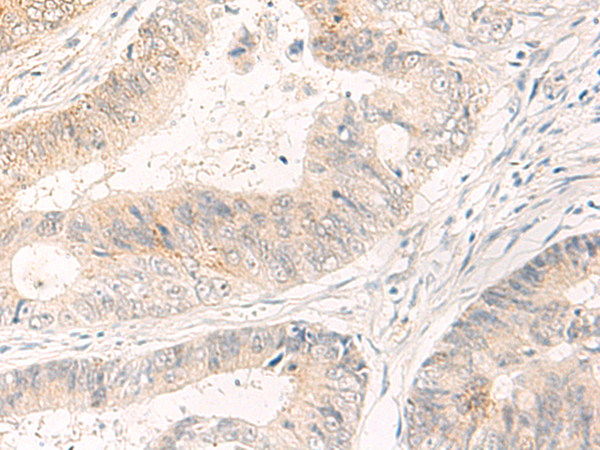Immunohistochemistry of paraffin-embedded Human colorectal cancer tissue using TA367555 (SYT16 Antibody) at dilution 1/30 (Original magnification: x200)