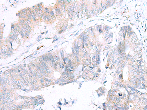 Immunohistochemistry of paraffin-embedded Human colorectal cancer tissue using TA367568 (NUDT8 Antibody) at dilution 1/25 (Original magnification: x200)