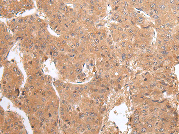 Immunohistochemistry of paraffin-embedded Human liver cancer tissue using TA367573 (GADD45GIP1 Antibody) at dilution 1/20 (Original magnification: x200)