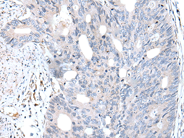 Immunohistochemistry of paraffin-embedded Human colorectal cancer tissue using TA367654 (FABP12 Antibody) at dilution 1/30 (Original magnification: x200)