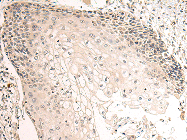 Immunohistochemistry of paraffin-embedded Human esophagus cancer tissue using TA367733 (KCNQ3 Antibody) at dilution 1/50 (Original magnification: x200)
