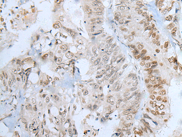 Immunohistochemistry of paraffin-embedded Human colorectal cancer tissue using TA367763 (ZNF143 Antibody) at dilution 1/20 (Original magnification: x200)