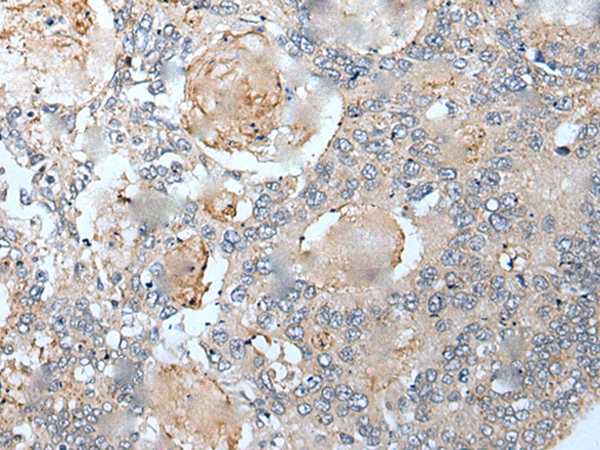 Immunohistochemistry of paraffin-embedded Human colorectal cancer tissue using TA367813 (VEZT Antibody) at dilution 1/30 (Original magnification: x200)