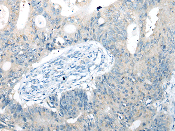 Immunohistochemistry of paraffin-embedded Human colorectal cancer tissue using TA367827 (UBXN10 Antibody) at dilution 1/25 (Original magnification: x200)