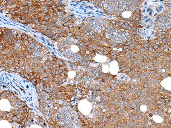Immunohistochemistry of paraffin-embedded Human ovarian cancer tissue using TA367832 (UGGT2 Antibody) at dilution 1/20 (Original magnification: x200)