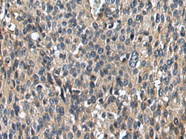 Immunohistochemistry of paraffin-embedded Human cervical cancer tissue using TA367835 (UNC5B Antibody) at dilution 1/35 (Original magnification: x200)