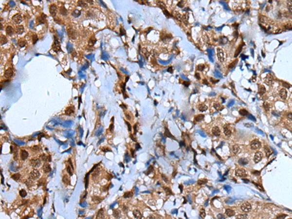 Immunohistochemistry of paraffin-embedded Human breast cancer tissue using TA367838 (UNCX Antibody) at dilution 1/25 (Original magnification: x200)