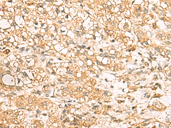 Immunohistochemistry of paraffin-embedded Human liver cancer tissue using TA367841 (USP24 Antibody) at dilution 1/35 (Original magnification: x200)