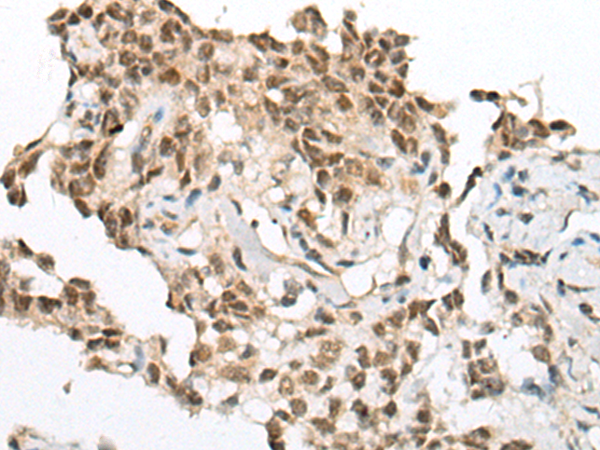 Immunohistochemistry of paraffin-embedded Human ovarian cancer tissue using TA367844 (UTP18 Antibody) at dilution 1/25 (Original magnification: x200)