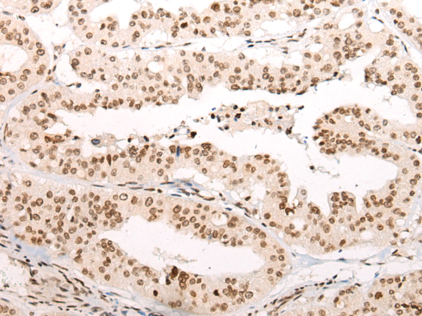 Immunohistochemistry of paraffin-embedded Human liver cancer tissue using TA367896 (VPS51 Antibody) at dilution 1/65 (Original magnification: x200)