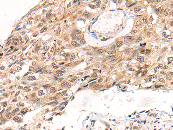 Immunohistochemistry of paraffin-embedded Human esophagus cancer tissue using TA367905 (KNOP1 Antibody) at dilution 1/85 (Original magnification: x200)