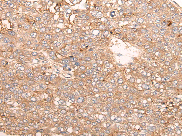 Immunohistochemistry of paraffin-embedded Human liver cancer tissue using TA367908 (SIGLECL1 Antibody) at dilution 1/65 (Original magnification: x200)