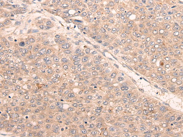 Immunohistochemistry of paraffin-embedded Human liver cancer tissue using TA367909 (KDF1 Antibody) at dilution 1/25 (Original magnification: x200)