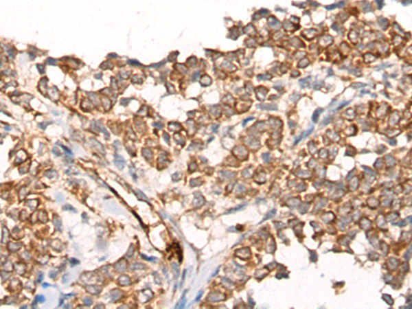 Immunohistochemistry of paraffin-embedded Human ovarian cancer tissue using TA367918 (CA5B Antibody) at dilution 1/65 (Original magnification: x200)