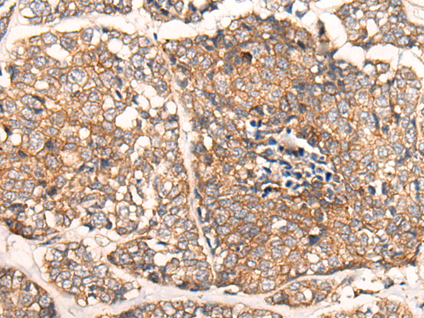 Immunohistochemistry of paraffin-embedded Human esophagus cancer tissue using TA367921 (CACNA2D2 Antibody) at dilution 1/45 (Original magnification: x200)