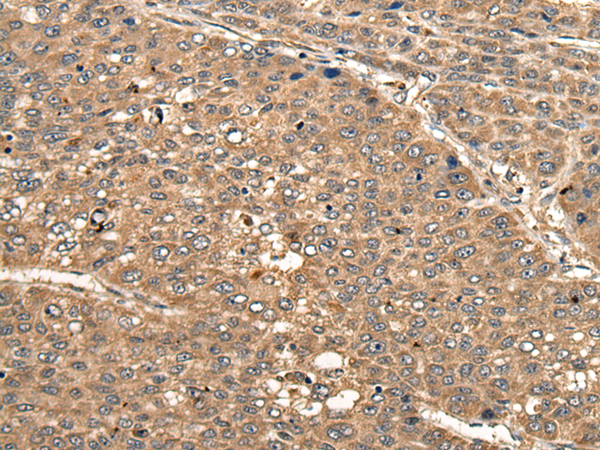 Immunohistochemistry of paraffin-embedded Human liver cancer tissue using TA367949 (CCDC102A Antibody) at dilution 1/20 (Original magnification: x200)