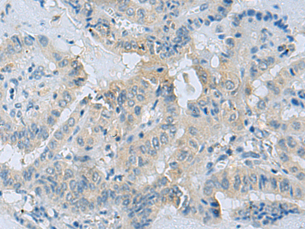 Immunohistochemistry of paraffin-embedded Human thyroid cancer tissue using TA367966 (CDH12 Antibody) at dilution 1/35 (Original magnification: x200)