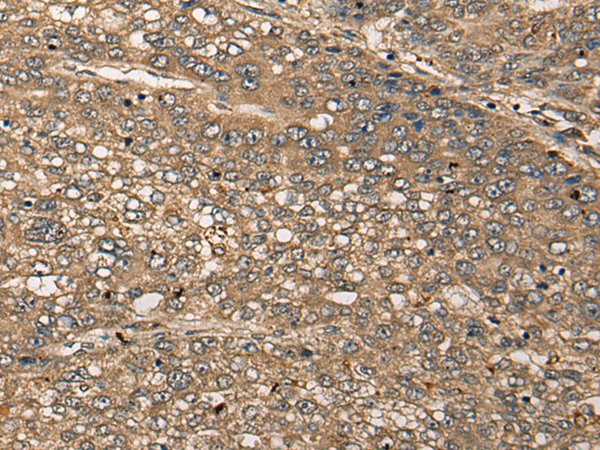 Immunohistochemistry of paraffin-embedded Human liver cancer tissue using TA367971 (CDRT15L2 Antibody) at dilution 1/25 (Original magnification: x200)