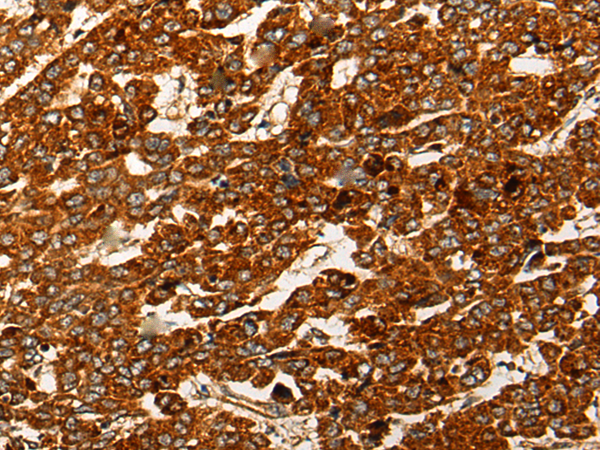 Immunohistochemistry of paraffin-embedded Human liver cancer tissue using TA367983 (CNTLN Antibody) at dilution 1/25 (Original magnification: x200)