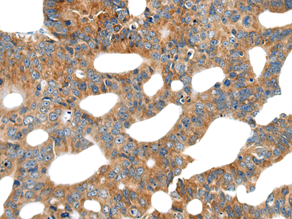 Immunohistochemistry of paraffin-embedded Human colorectal cancer tissue using TA367984 (CEP104 Antibody) at dilution 1/25 (Original magnification: x200)