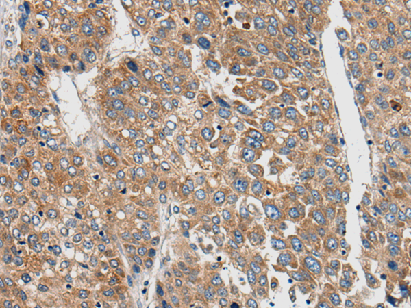 Immunohistochemistry of paraffin-embedded Human liver cancer tissue using TA368018 (CNTN5 Antibody) at dilution 1/30 (Original magnification: x200)